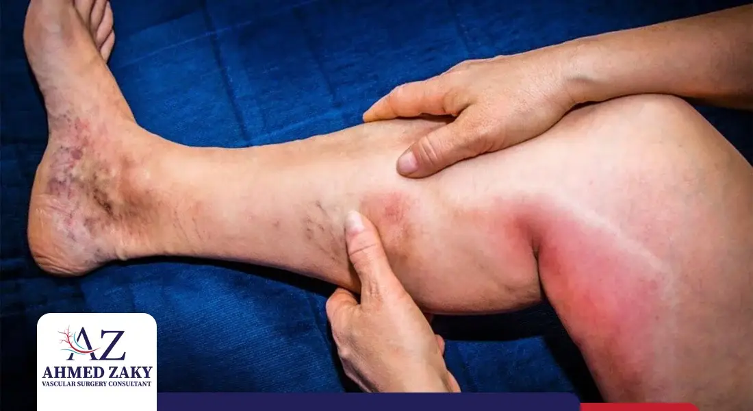 علاج جلطات الساق