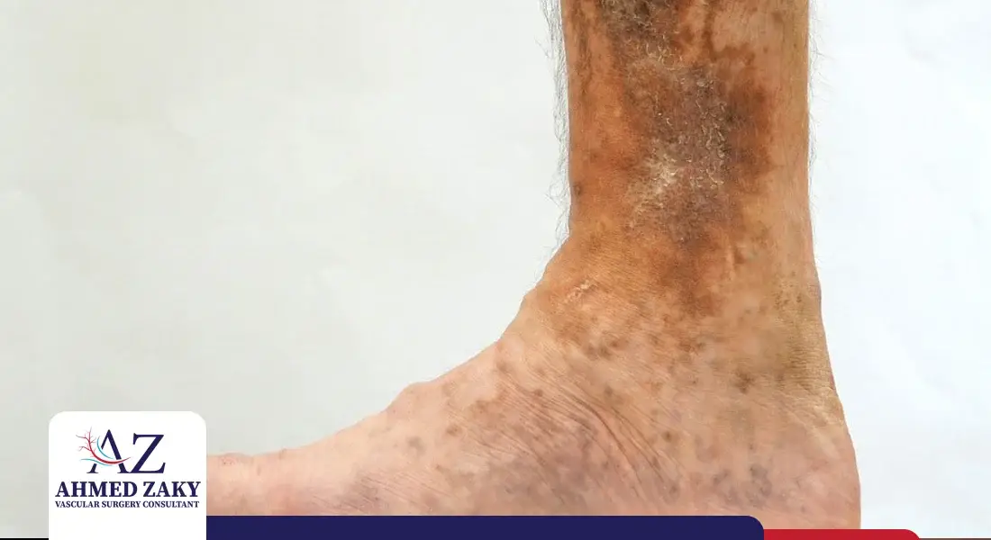 علاج قرحة الساق الوريدية