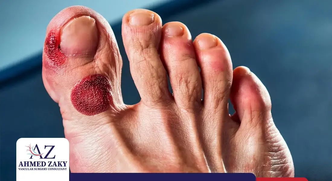 أعراض القدم السكري بالصور